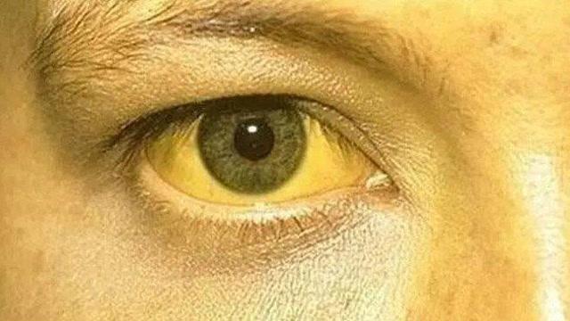 眼睛发黄是什么病